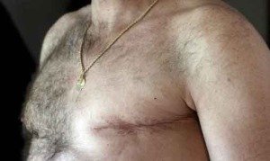 Breast Cancer in men